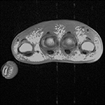 Radiofrequency interference artifact