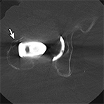 Periprosthetic fracture